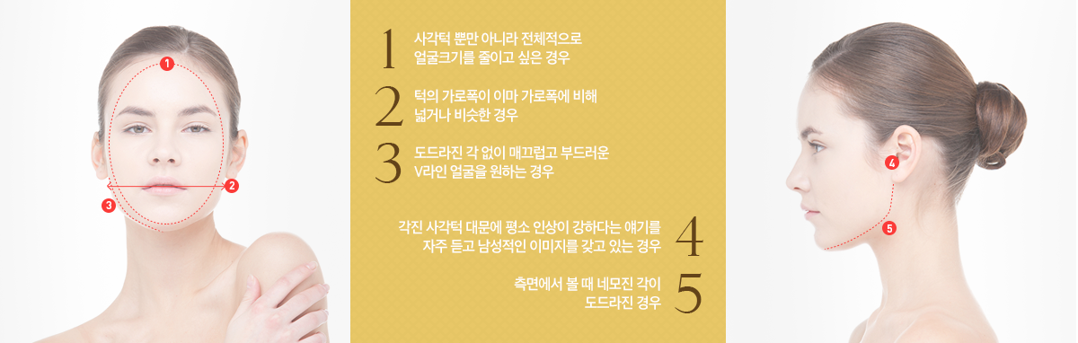 사각턱수술