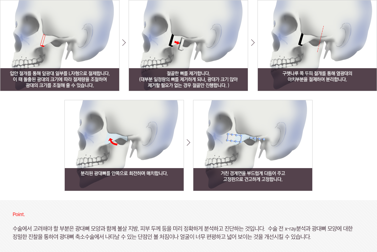 광대뼈축소술