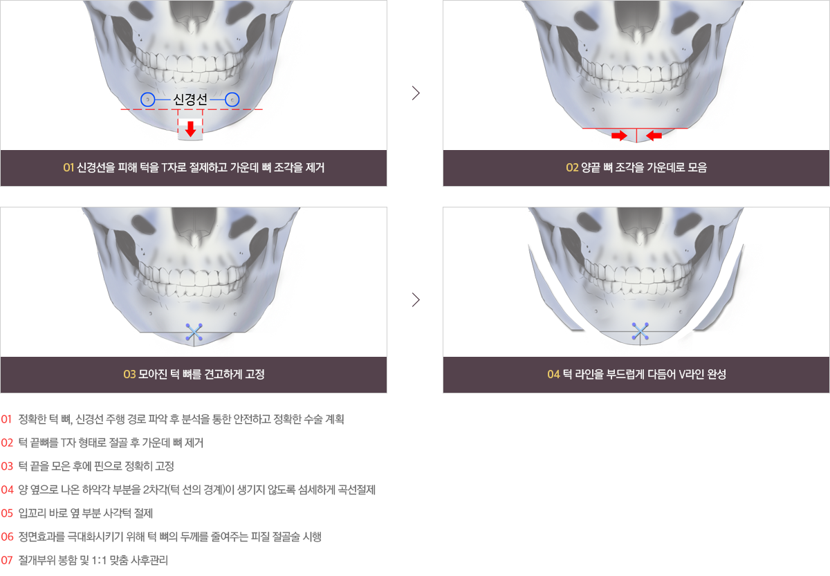 턱끝성형술