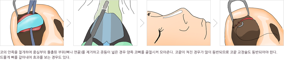 매부리코