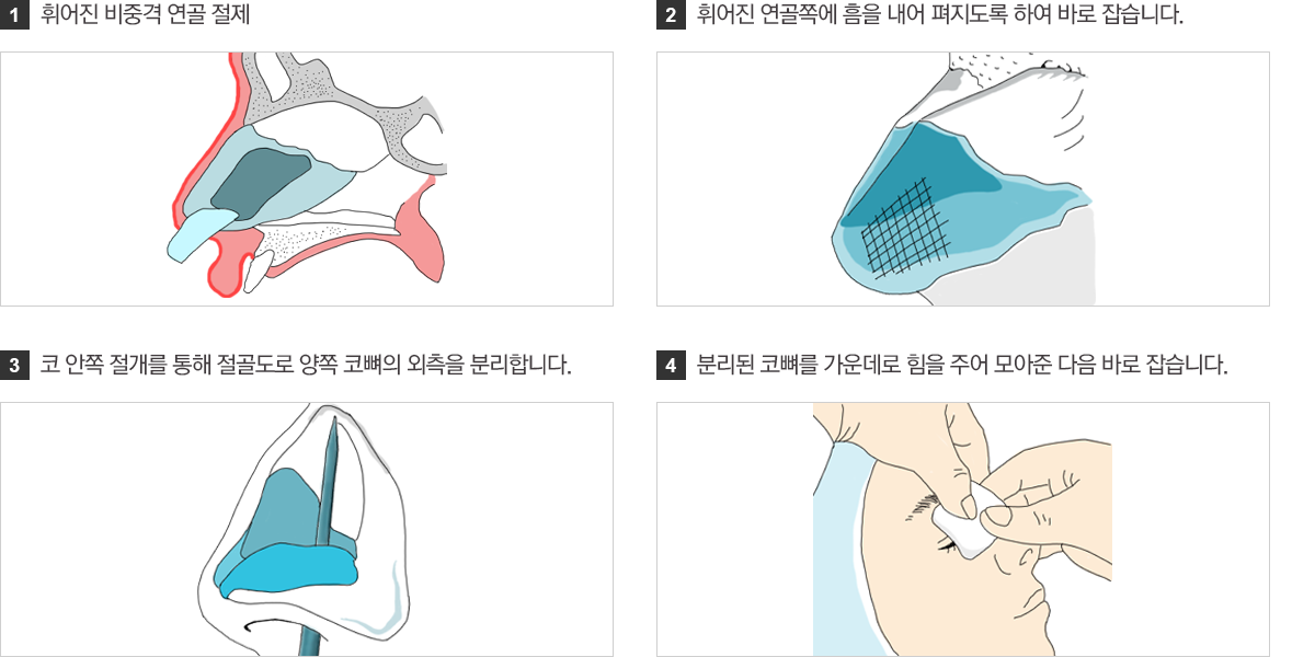 휘어진코