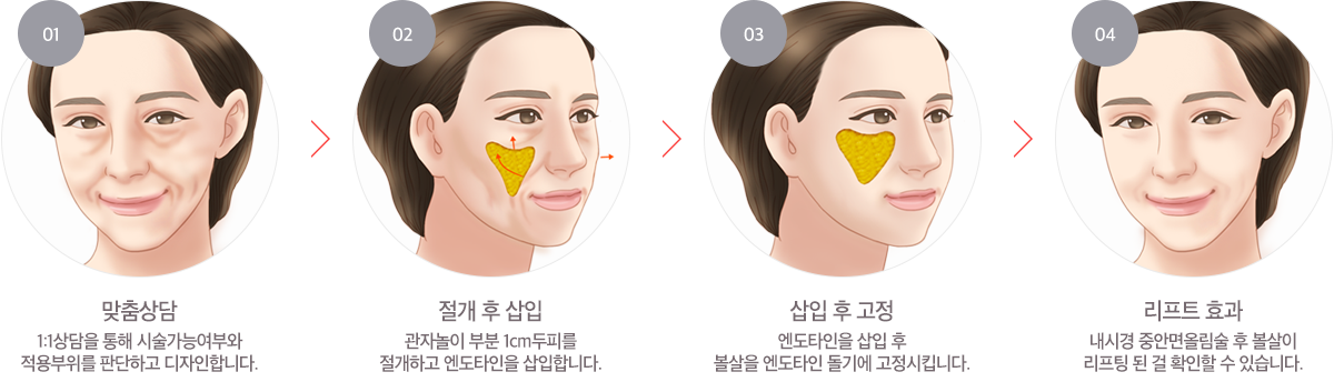 내시경중안면올림술