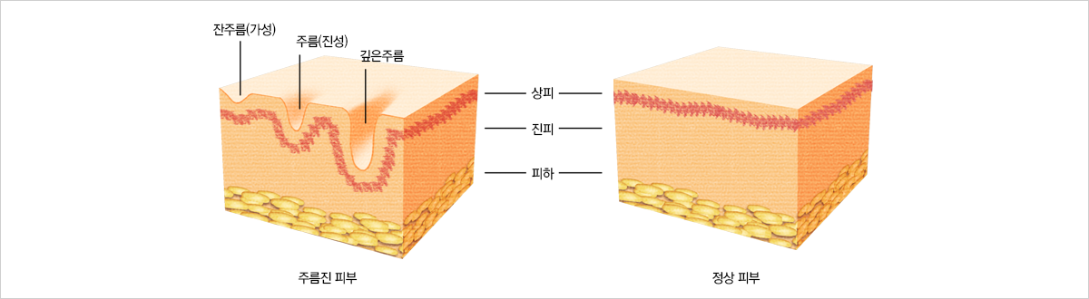 주름성형