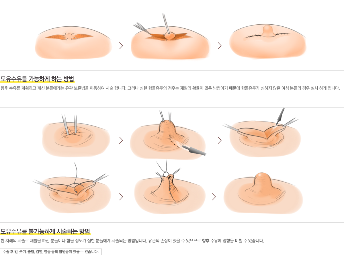 유두성형