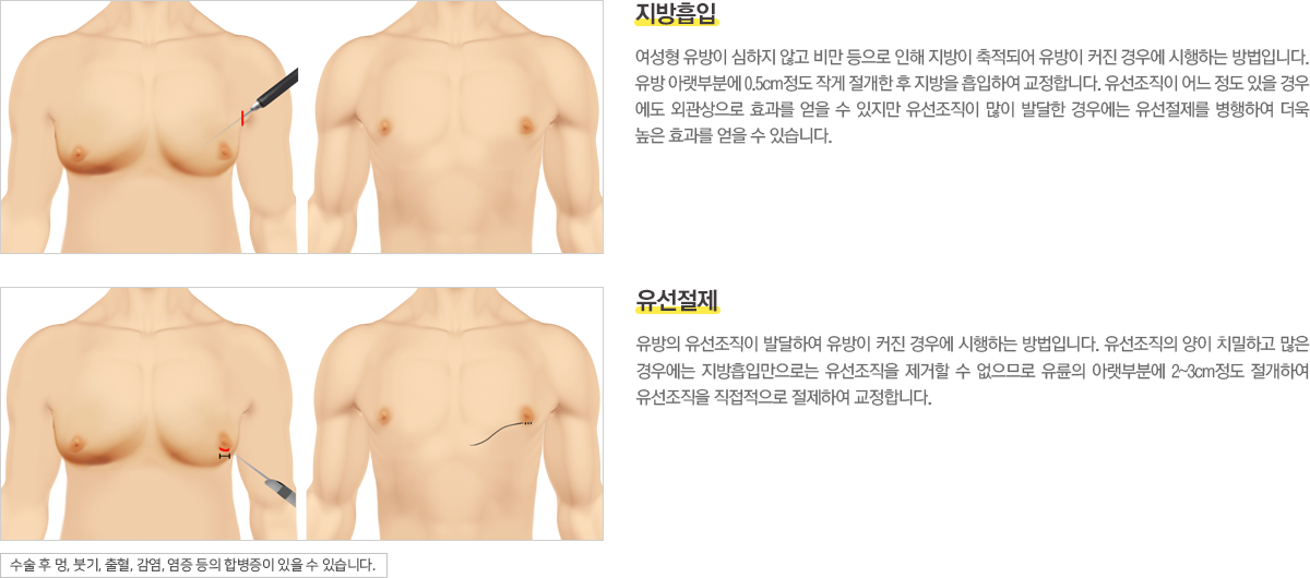 여성형유방