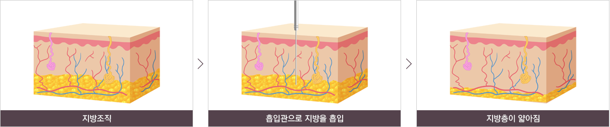 지방흡입